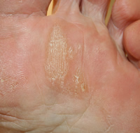 Plantar Foot Callus