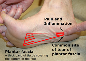 Lateral Plantar Fascia Pain