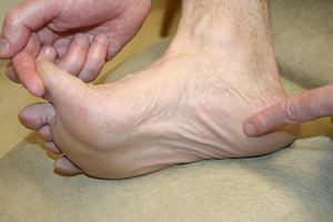 Plantar Fasciitis