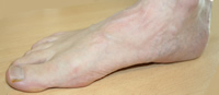 Right foot medial aspect