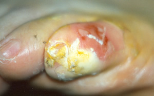 Patient's own treatment with salicylic acid has made the little toe extremely painful