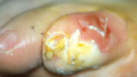 Salicylic Acid Damage to Skin