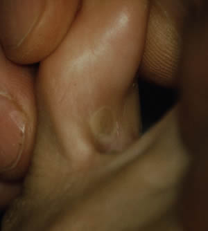 Soft corn between toes