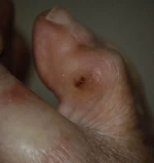 Soft corn between toes