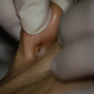 Soft corn between toes