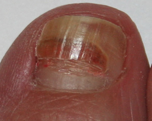 Bruised toenail