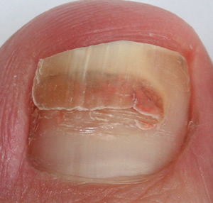 What does a bruised toenail look like