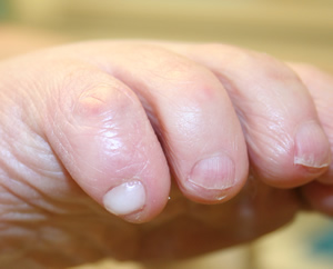 Charcot Marie Tooth Disease - 5th toenail reconstruction with Wilde Pedique UV nail gel